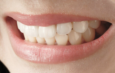 歯ぎしり・噛み締め治療にボツリヌストキシン治療