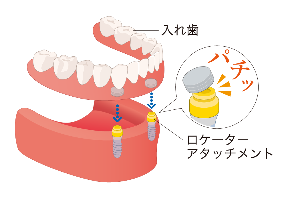 インプラント・ロケーターアタッチメント